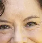 NANCY-Stress-Urinary-Incontinence